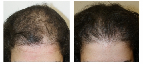 Manual Hair Transplantation