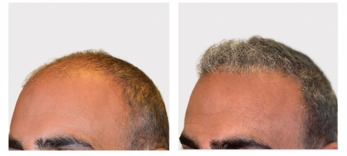 Hair Transplantation Before After