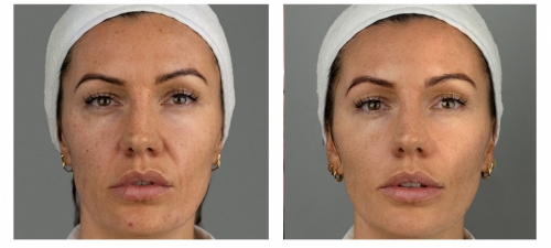 Face Rejuvenation