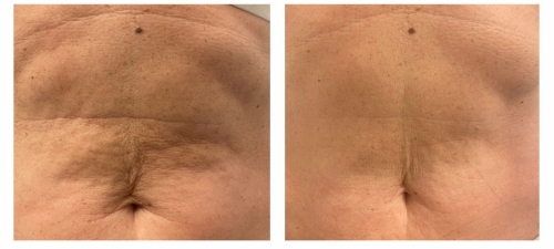 Genius RF Microneedling Before After